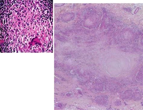 cutaneous tuberculosis