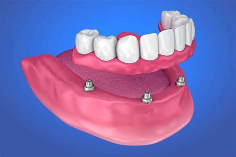 Traditional vs. Implant Supported Dentures | Smile Dental Center