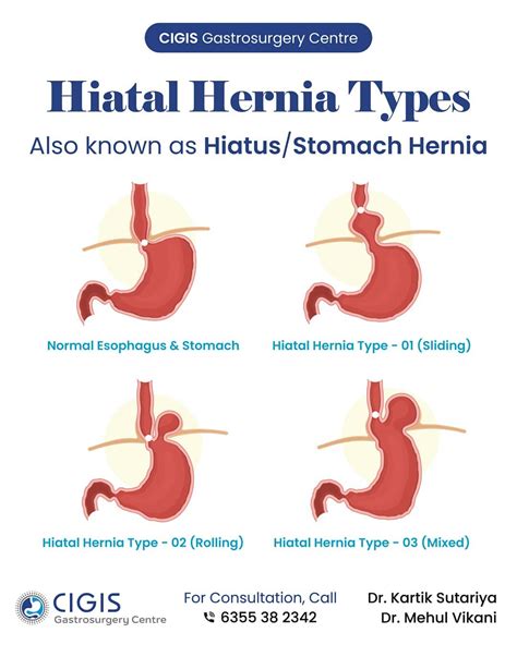 CIGIS Hospital Types Of Hiatal Hernia Also Known As Hiatus , 50% OFF