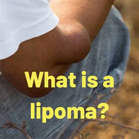 WHAT IS A LIPOMA? | London Shoulder & Elbow Surgeon