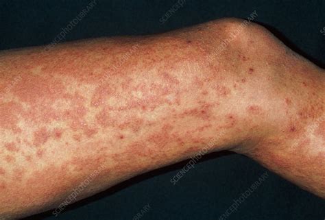 Urticaria rash (hives) on legs due to exam stress - Stock Image - M280 ...