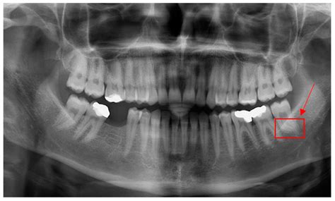 Applied Sciences | Free Full-Text | Root Dilaceration Using Deep Learning: A Diagnostic Approach