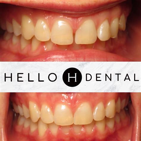 Before and After Photo Gallery | Hello Dental