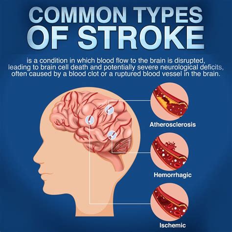 Understanding Stroke: Causes, Symptoms, and Treatments