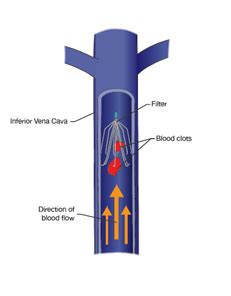 Inferior Vena Cava Filter