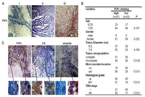 Tumor: Tumor Marker For Colon Cancer