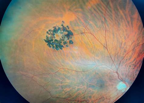 Operculated Retinal Hole