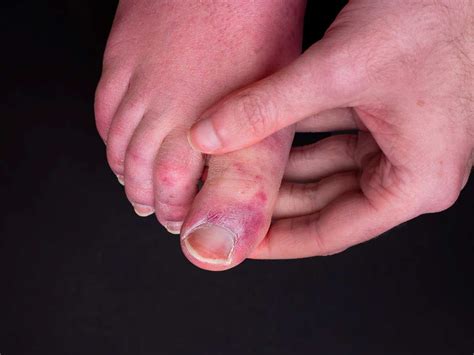 How to Prevent and Treat Chilblains Toes and Fingers - Survival World