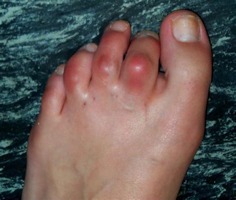 Hammer Toe - Causes, Symptoms, Treatment, Surgery, Pictures, Splint ...