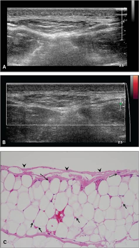 Sonographic Differentiation Between Angiolipomas and Superficial Lipomas - Shin - 2016 - Journal ...