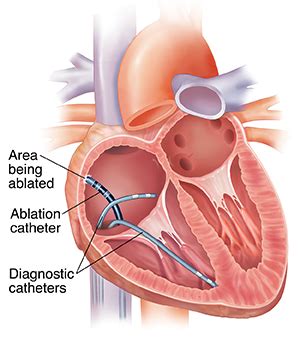 Having Catheter Ablation | Saint Luke's Health System