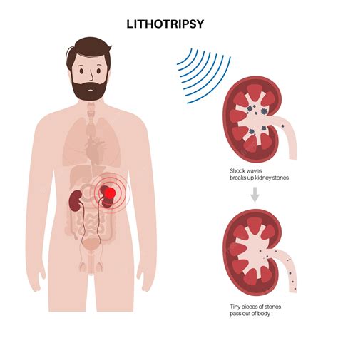 Premium Vector | Lithotripsy procedure concept