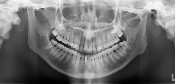 Reduce Your Panoramic Imaging Errors - Dimensions of Dental Hygiene