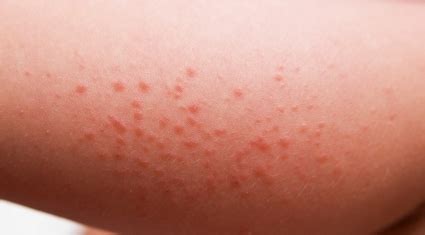 Different Types of Rashes - Eczema Free Skin