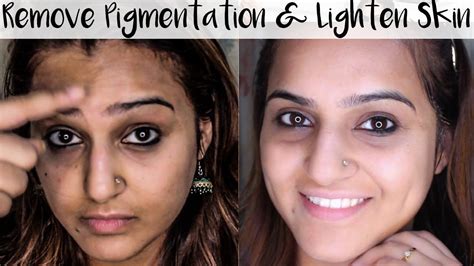 How to Get Rid of Pigmentation, Dark Spots, Discoloration & Lighten ...