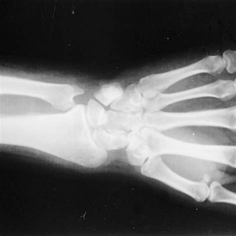 Schamroth test: (a) normal finger, and (b) space between nails is... | Download Scientific Diagram