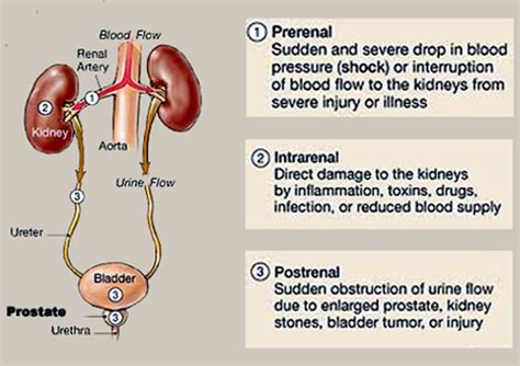 Prerenal-Intrarenal-Postrenal - Acute Renal Failure