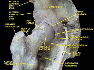 Hip dislocation - WikEM