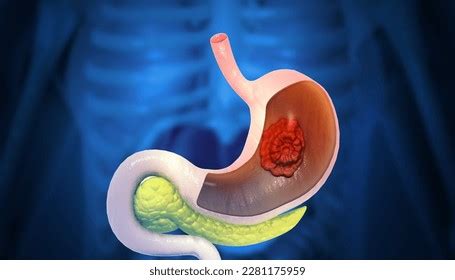 Stomach Cancer Gastric Cancer Symptoms Stages Stock Illustration ...