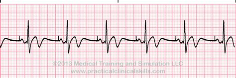 Ventricular Paced Rhythm