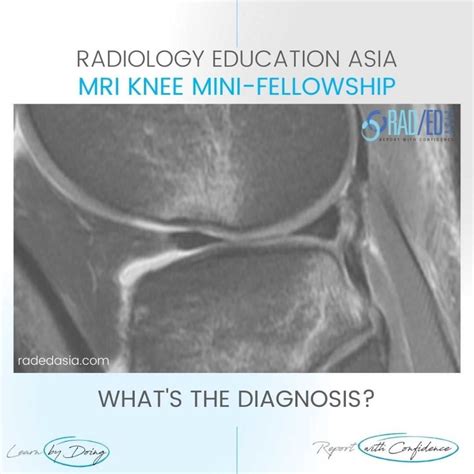 ACL TEAR PIVOT SHIFT INJURY BONE CONTUSION PATTERN OSTEOCHONDRAL FRACTURE MRI KNEE - Radedasia