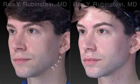 Chin Filler, Jawline Filler Photos | Newburgh, NY | Patient 19962