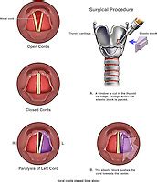 Unilateral Vocal Cord Paralysis with Surgical Repair | Doctor Stock