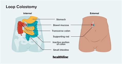 Loop Colostomy Reversal
