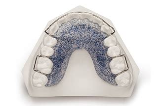 Hawley Retainer with Adams Clasps | DDS Lab