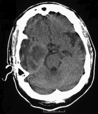 Glioblastoma Multiforme Treatment & Management: Medical Care, Surgical Care, Consultations