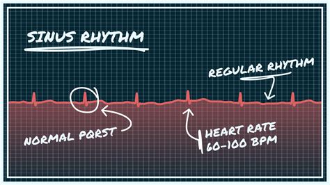 What Sinus Rhythm Looks Like on Your Watch ECG | Qaly