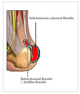 Achilles Bursitis Treatment | OSMO Patch US