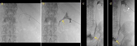 Ureteric stent insertion - Radiology at St. Vincent's University Hospital