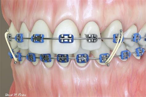 elastics-3 - Forbes Orthodontics