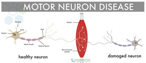 Stem Cell Treatment for Motor Neuron Disease MND