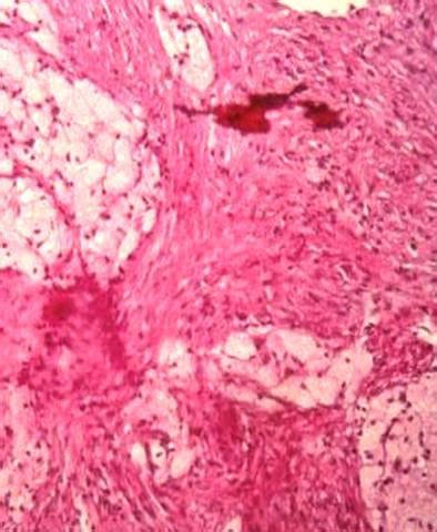 Histiocytoma (Benign Fibrous Histiocytoma) - Pathology - Orthobullets