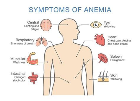 Anemia; 13 Warning Signs & Symptoms of Anemia - Page 13 of 13 - Left Side Pains