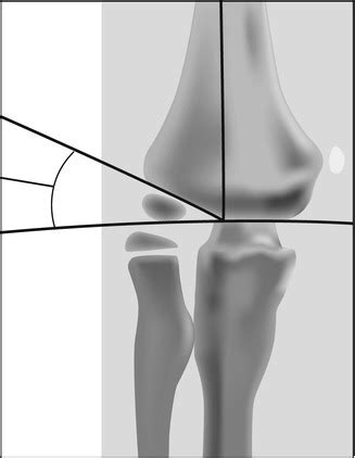 Supracondylar Humerus Fracture | Obgyn Key