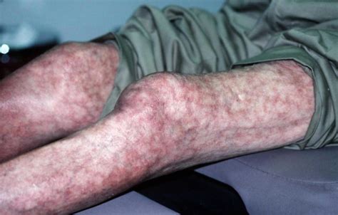 Mottled skin or livedo reticularis causes, diagnosis and treatment