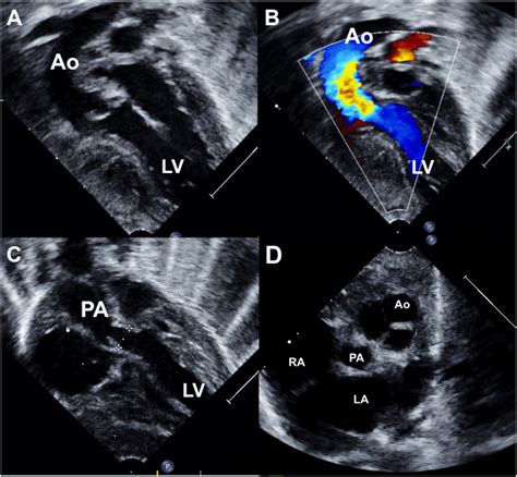 Echocardiogram of second patient continued (Movie 4) A modified apical ...