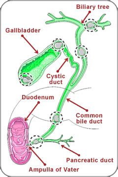 Gallstones & Bile Duct Stones | MUSC Health | Charleston SC