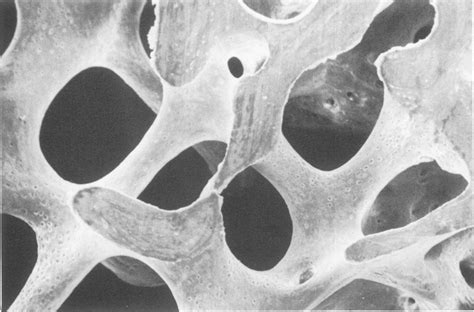 Scanning electron micrograph of trabecular bone illustrating the ...