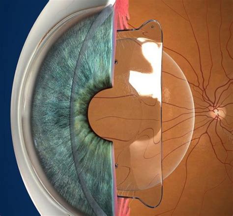 icl-2 - Bloomberg Eye Center