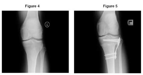 High Tibial Osteotomy - Patient Information Brochures - Mater Group