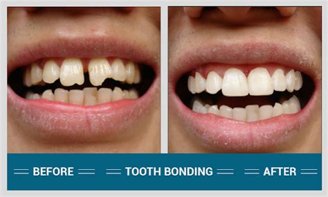 Tooth Bonding - Facts You Should Know about It ~ Dental Blog: Latest ...