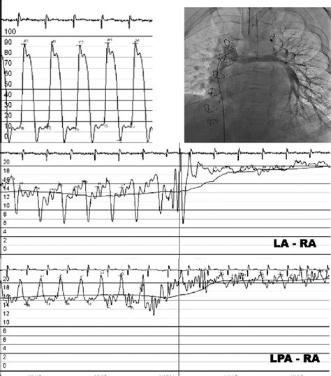 Hemodynamic study in a 13‑year‑old boy after staged fenestrated Fontan ...