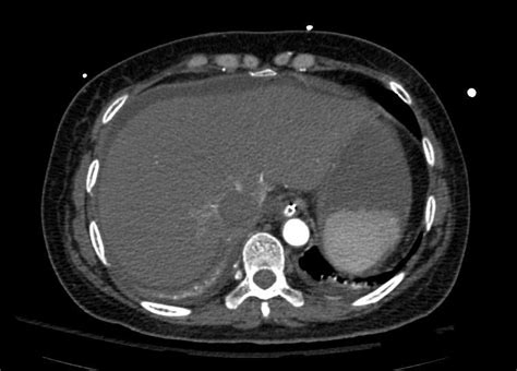 Intravenous leiomyomatosis - wikidoc