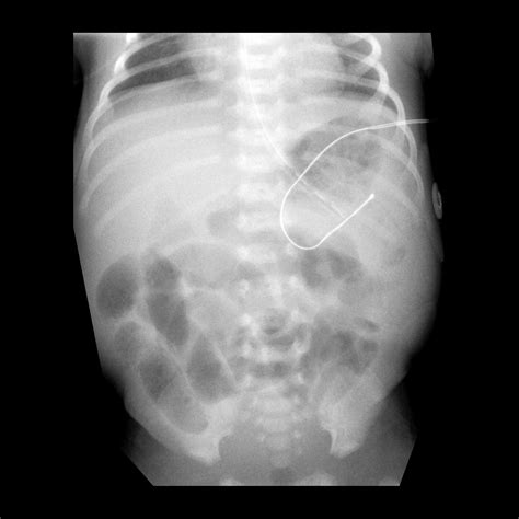 Necrotizing Enterocolitis | Pediatric Radiology Reference Article ...