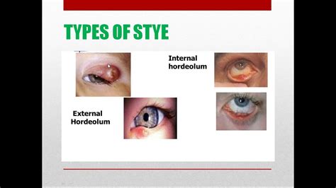 A Class On STYE,CHALAZION & INTERNAL HORDEOLUM By Dr Suman Dept Of ...