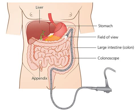 A Closer Look at: Colonoscopy - The Waiting Room